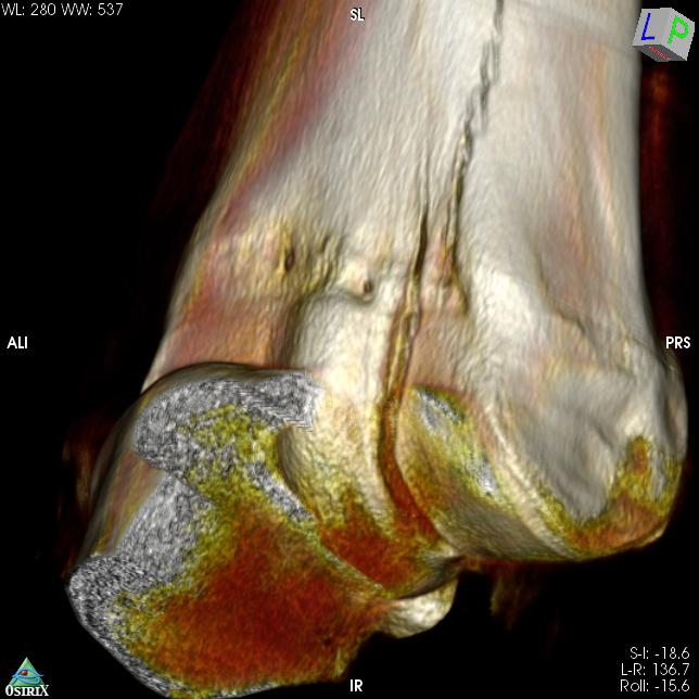 incomplete-condylar-fracture3D